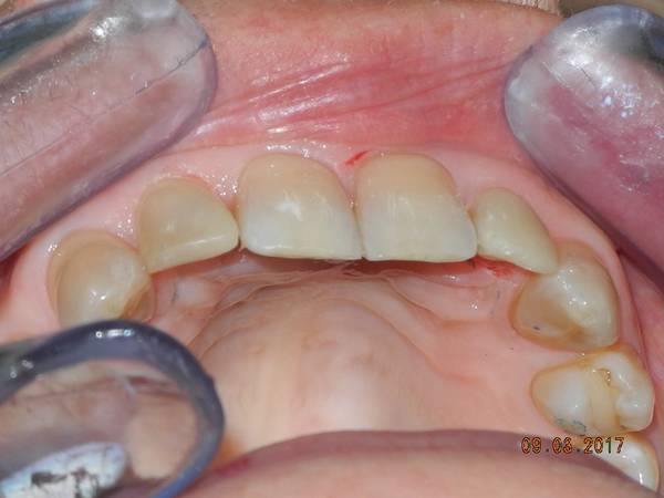 studio dentistico brogi ricostruzione incisivi superiori dopo centrale sotto