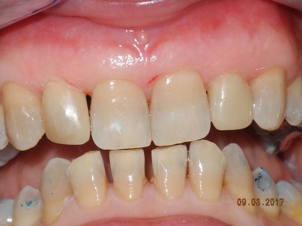 studio dentistico brogi ricostruzione incisivi superiori dopo centrale