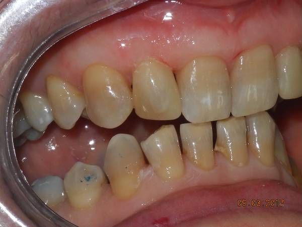 studio dentistico brogi ricostruzione incisivi superiori dopo destro
