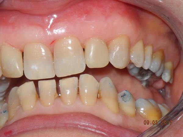 studio dentistico brogi ricostruzione incisivi superiori dopo sinistro