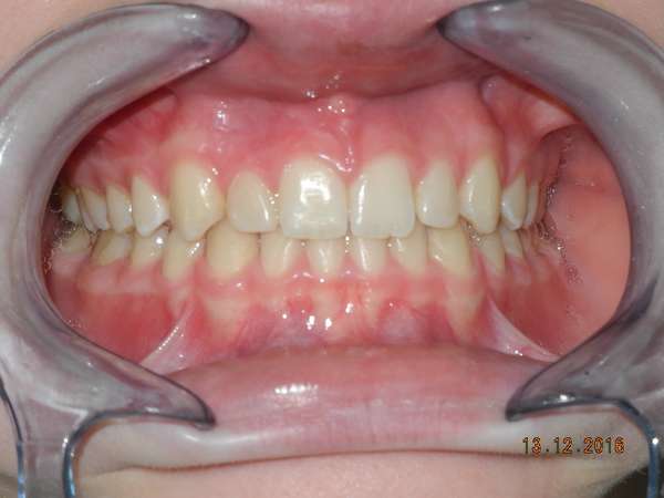 brogi malocclusione e diastemi fine terapia 