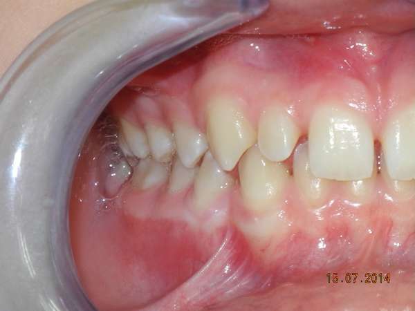 brogi malocclusione e diastemi vista dx