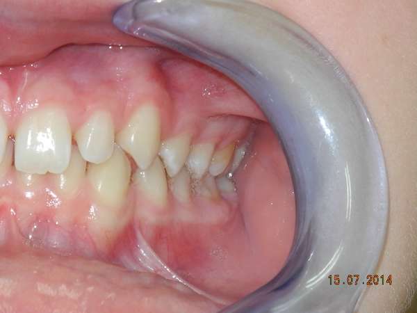 brogi malocclusione e diastemi vista sx