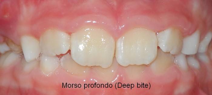 brogi ortodonzia intercettiva morso profondo