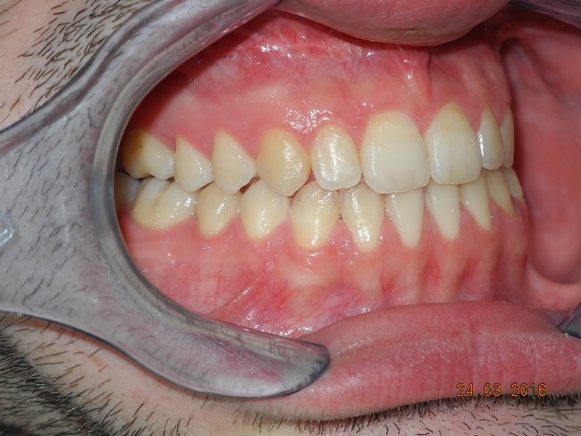 brogi paziente adulto open bite dopo trattamento 1