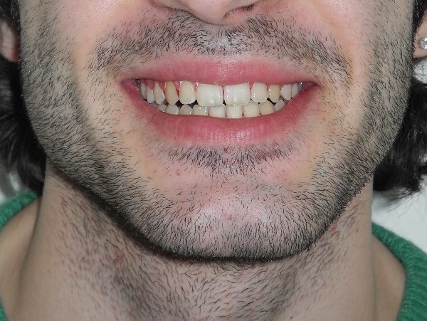 brogi paziente adulto open bite dopo trattamento 4
