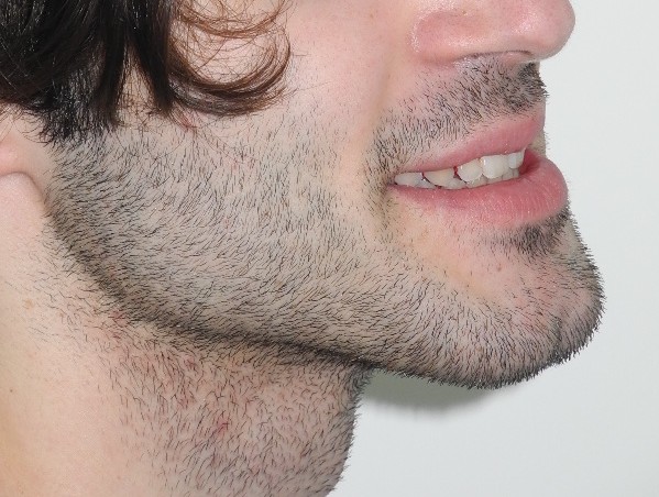 brogi paziente adulto open bite dopo trattamento 6