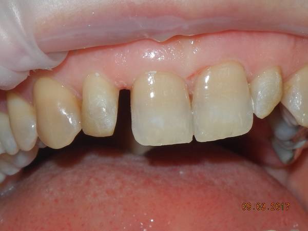 studio dentistico brogi ricostruzione incisivi superiori prima destro