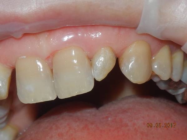 studio dentistico brogi ricostruzione incisivi superiori prima sinistro