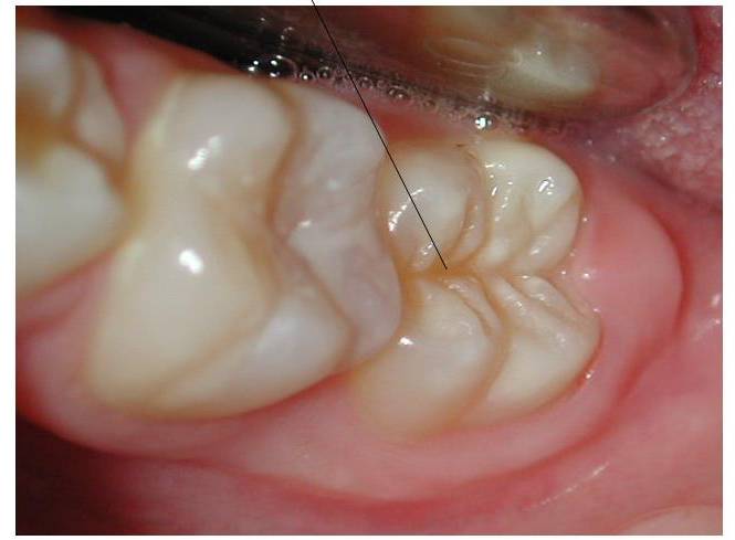 brogi protezione dei denti dente originale