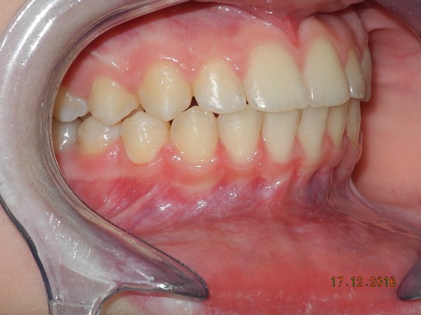 dott brogi dentista canini vestibolarizzati dopo dx