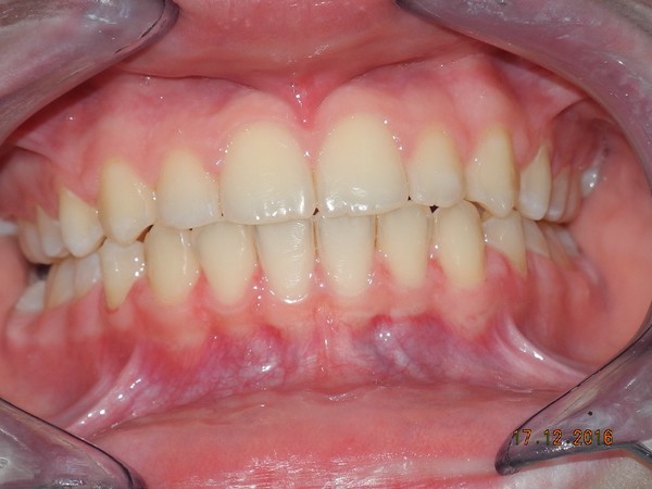 dott brogi dentista canini vestibolarizzati dopo frontale