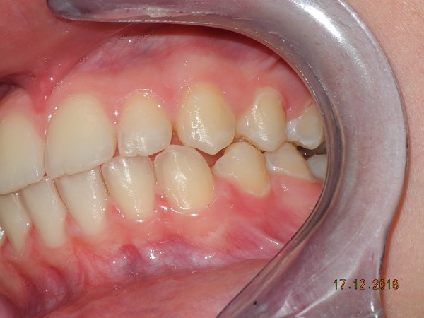 dott brogi dentista canini vestibolarizzati dopo sx