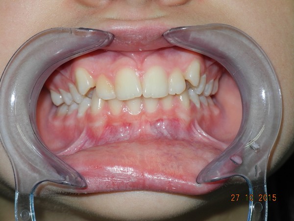 dott brogi dentista canini vestibolarizzati prima generale
