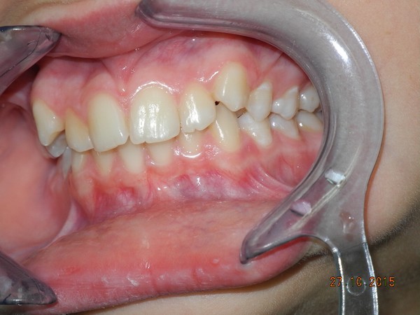 dott brogi dentista canini vestibolarizzati prima sx