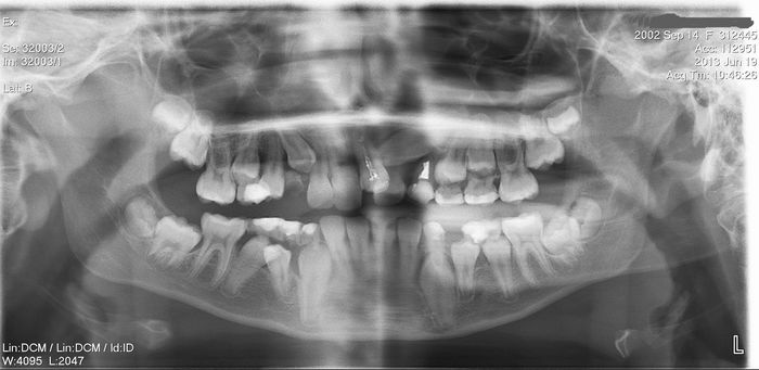 radiografia caso Canini inclusi e arcate 